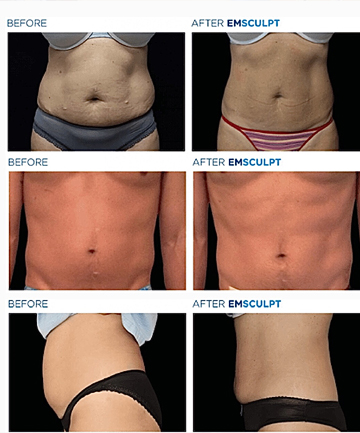 Why get Emsculpt?