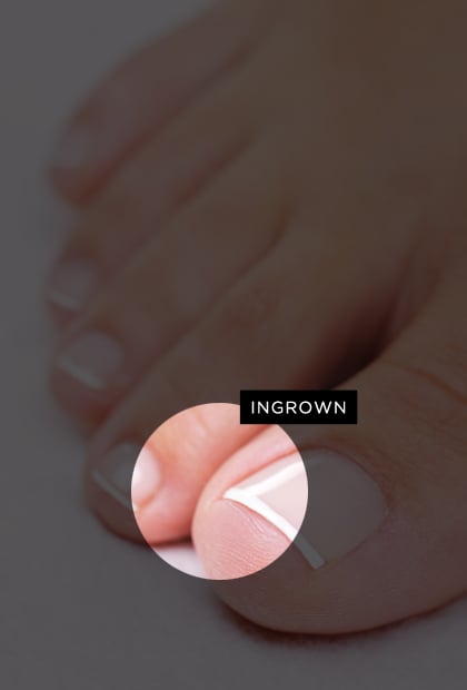 Ingrown toenails 