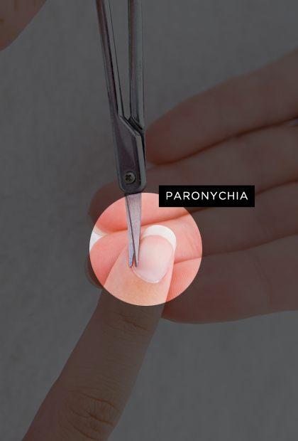 Paronychia