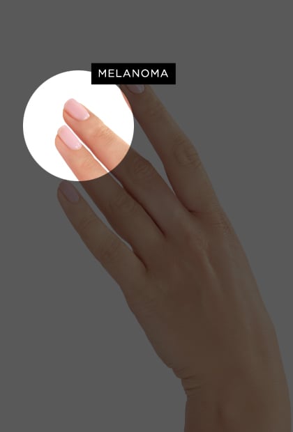 Melanoma 