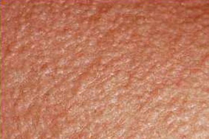 Skin Emergency: Heat Rash