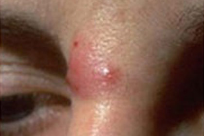 Skin Emergency: Cystic Acne