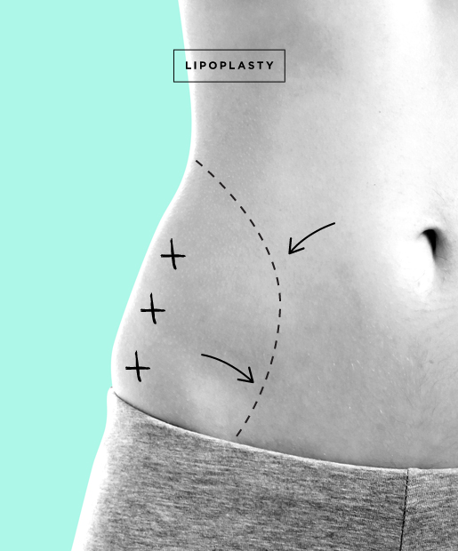 Liposuction aka Lipoplasty 