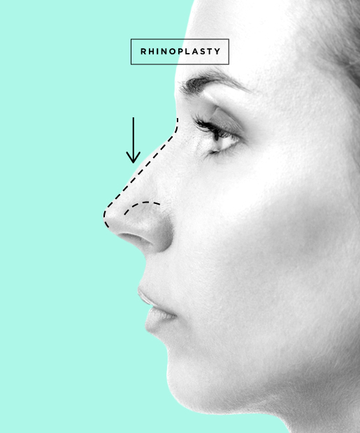 Nose Job aka Rhinoplasty 