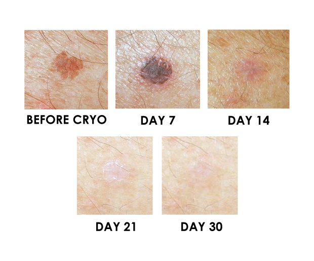 Sunspot fade progression from pre-treatment to day 30